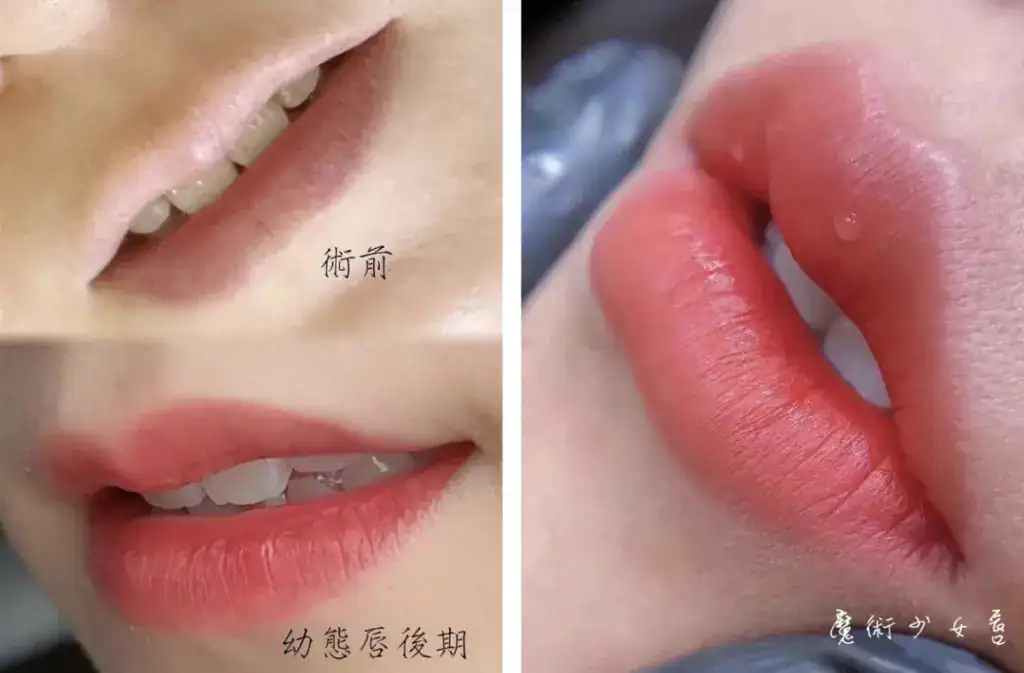 霧唇修復期